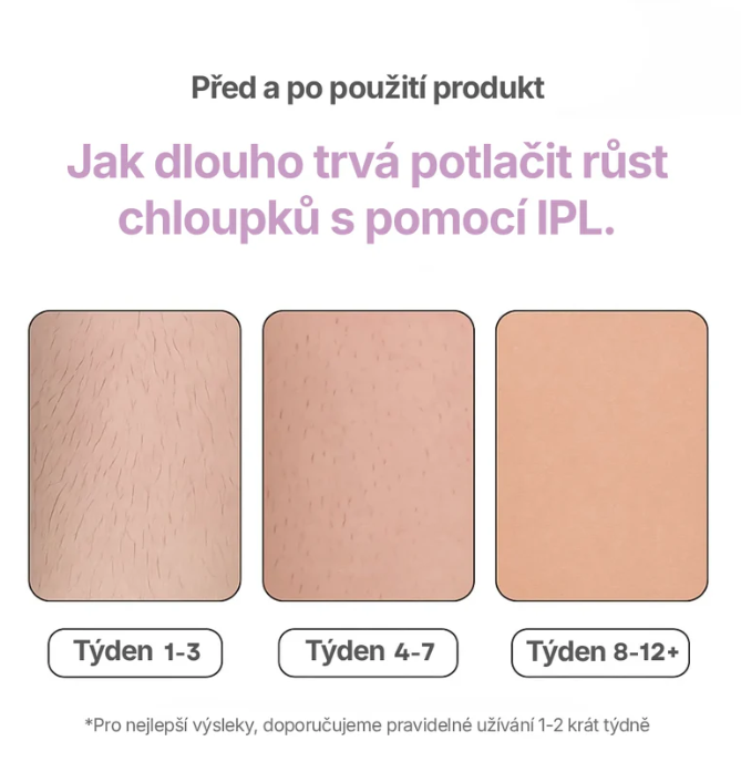SKINIEE: IPL Laserový Odstraňovač Chloupků